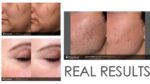 Picosure  laser for a refreshed look!